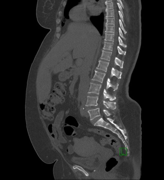 File:Chromophobe renal cell carcinoma (Radiopaedia 84239-99519 Sagittal bone window 60).jpg