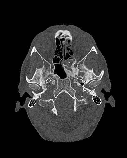 File:Chronic maxillary sinusitis caused by a foreign body (Radiopaedia 58521-65676 Axial bone window 202).jpg