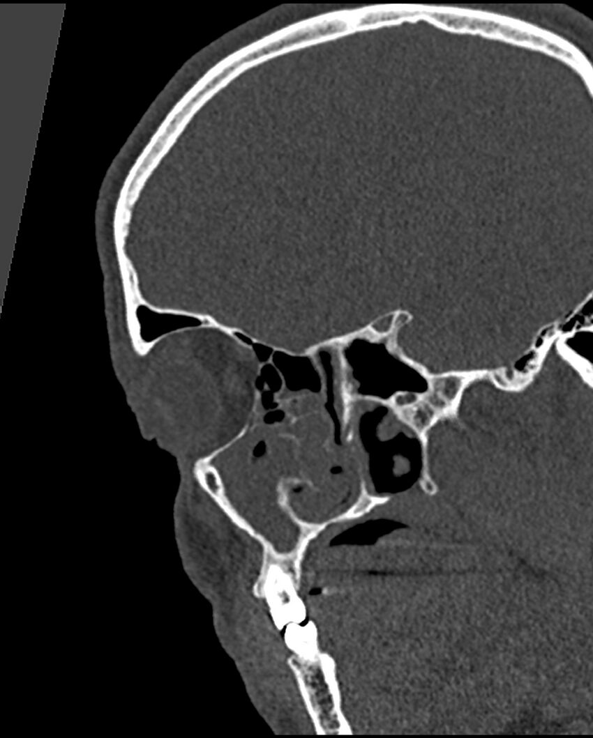 Chronic maxillary sinusitis caused by a foreign body (Radiopaedia 58521-65676 Sagittal bone window 6).jpg