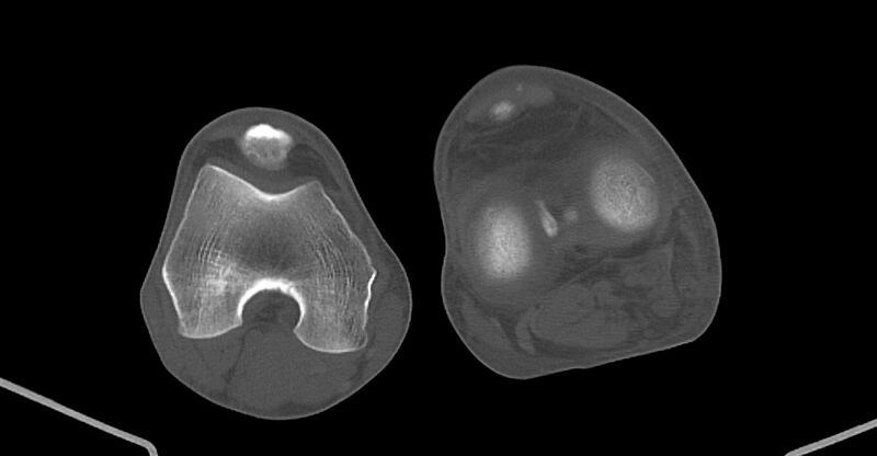 File:Chronic osteomyelitis (with sequestrum) (Radiopaedia 74813-85822 Axial non-contrast 188).jpg