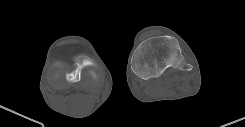 File:Chronic osteomyelitis (with sequestrum) (Radiopaedia 74813-85822 Axial non-contrast 196).jpg