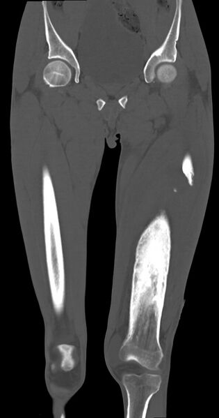 File:Chronic osteomyelitis (with sequestrum) (Radiopaedia 74813-85822 Coronal non-contrast 21).jpg