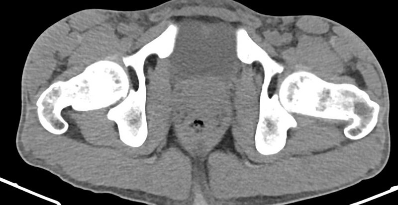 File:Chronic osteomyelitis (with sequestrum) (Radiopaedia 74813-85822 D 42).jpg