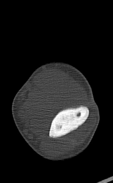 File:Chronic osteomyelitis of the distal humerus (Radiopaedia 78351-90971 Axial bone window 76).jpg