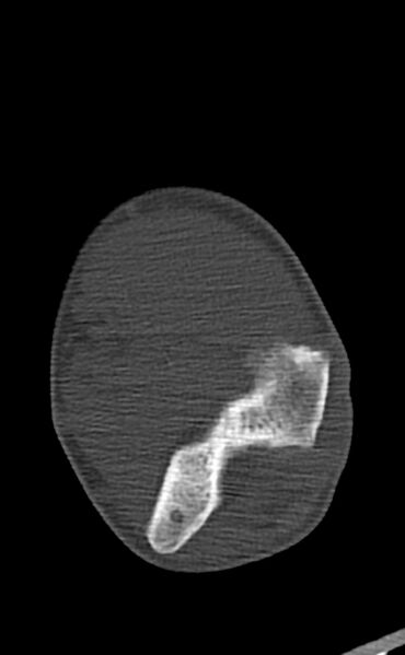 File:Chronic osteomyelitis of the distal humerus (Radiopaedia 78351-90971 Axial bone window 86).jpg