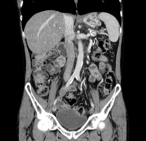 File:Chronic pancreatitis (Radiopaedia 23132-23172 C 31).jpg