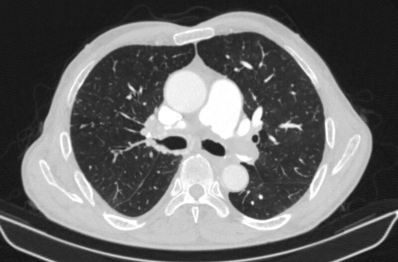 File:Chronic pulmonary embolism (Radiopaedia 91241-108843 Axial lung window 39).jpg