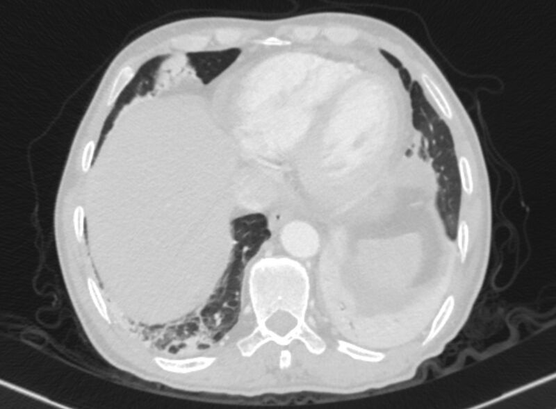 File:Chronic pulmonary embolism with bubbly consolidation (Radiopaedia 91248-108850 Axial lung window 126).jpg
