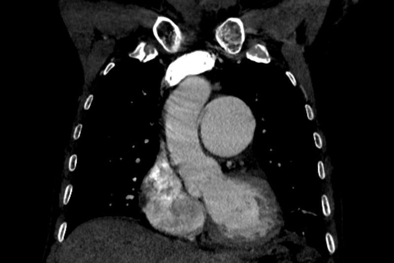 File:Chronic pulmonary embolism with bubbly consolidation (Radiopaedia 91248-108850 B 51).jpg