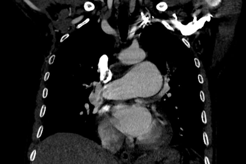 File:Chronic pulmonary embolism with bubbly consolidation (Radiopaedia 91248-108850 B 68).jpg