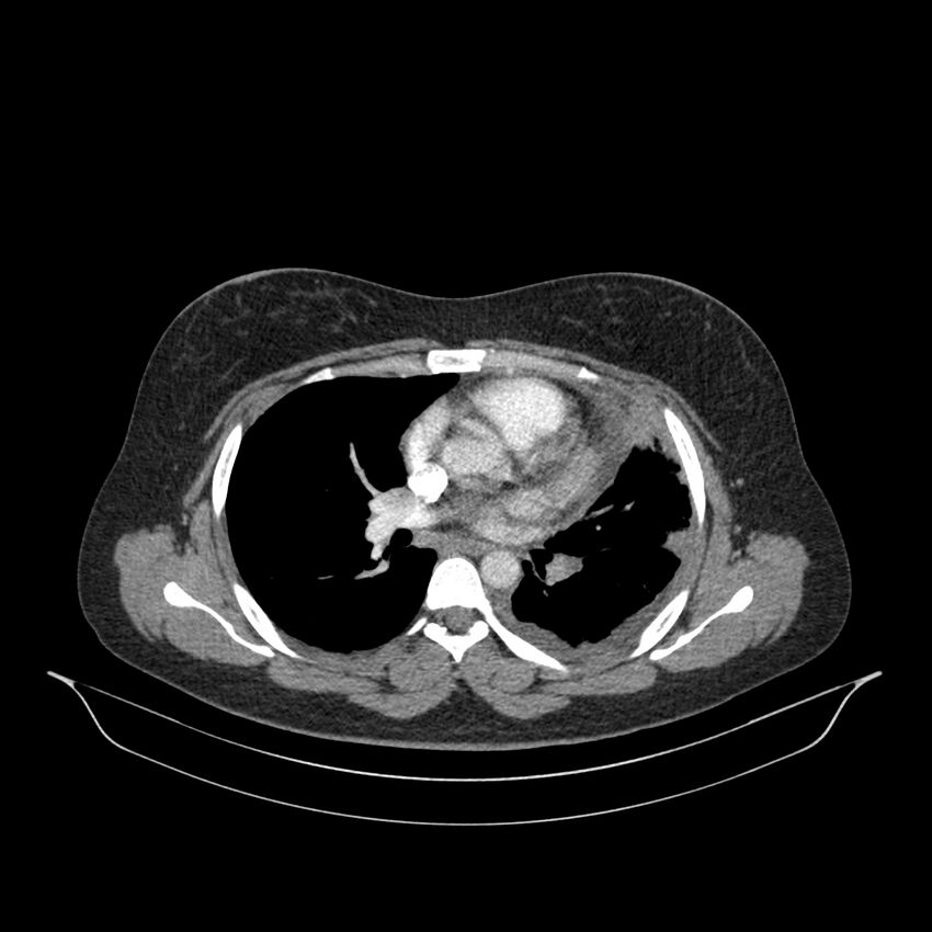 Chronic thromboembolic pulmonary hypertension (CTEPH) (Radiopaedia 74597-85532 Axial C+ CTPA 87).jpg