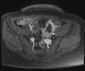 Class II Mullerian duct anomaly- unicornuate uterus with rudimentary horn and non-communicating cavity (Radiopaedia 39441-41755 Axial T1 fat sat 28).jpg