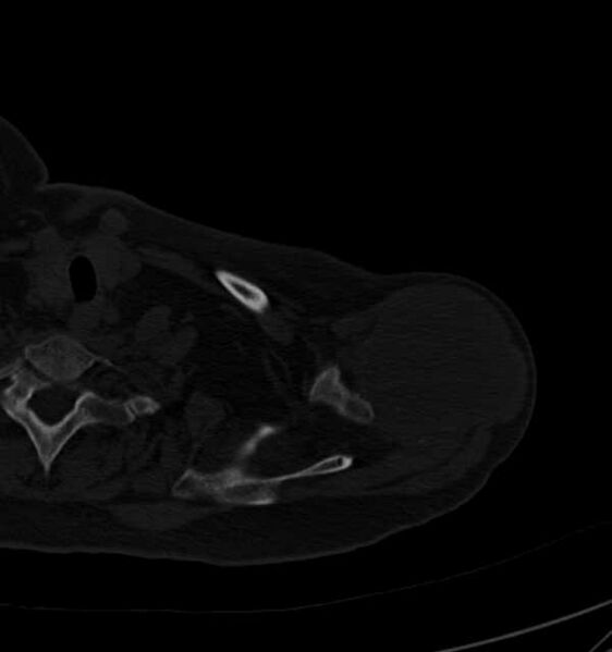 File:Clear cell chondrosarcoma - humerus (Radiopaedia 63104-71612 Axial bone window 21).jpg
