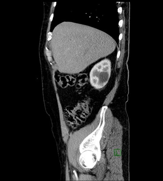 File:Clear cell renal cell carcinoma (Radiopaedia 85006-100539 E 48).jpg
