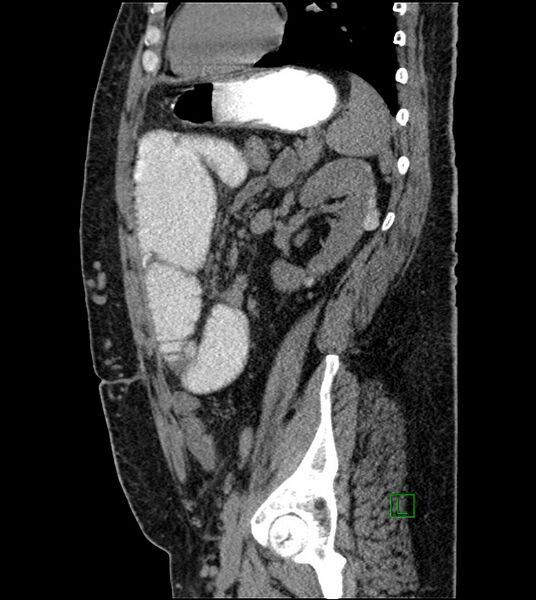 File:Closed-loop small bowel obstruction-internal hernia (Radiopaedia 78439-91096 C 53).jpg