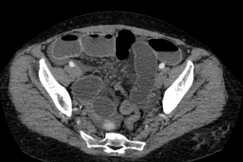 File:Closed loop small bowel obstruction (Radiopaedia 71211-81508 A 133).jpg