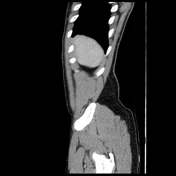 File:Co-existing acute appendicitis and epiploic appendagitis (Radiopaedia 61789-69911 B 8).jpg