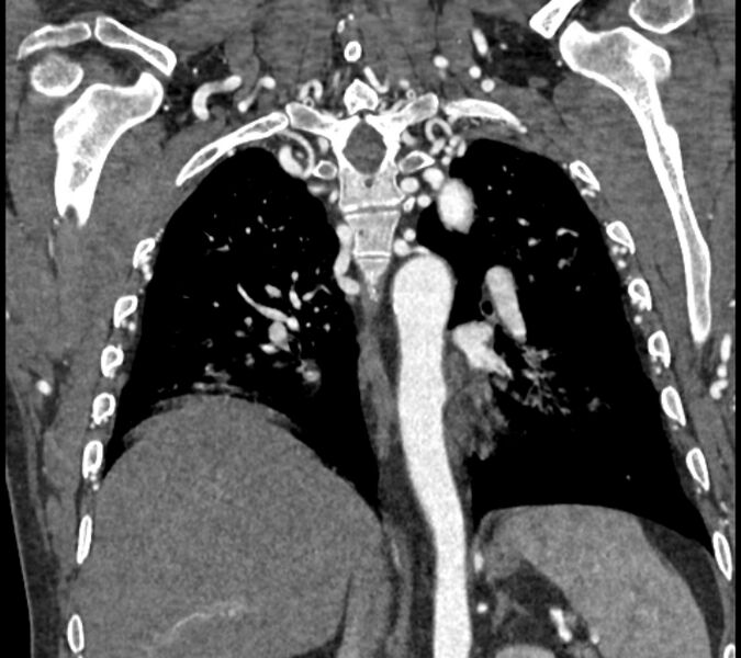 File:Coarctation of the aorta (Radiopaedia 53752-59822 B 54).jpg