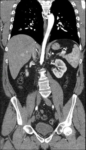 File:Coarctation of the aorta (Radiopaedia 74632-88521 B 139).jpg