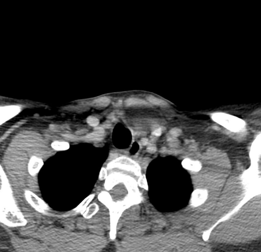 Colloid cyst of thyroid (Radiopaedia 22897-22923 Axial C+ delayed 69).jpg