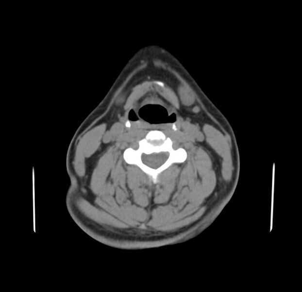 File:Colloid cyst of thyroid (Radiopaedia 22897-22923 Axial non-contrast 27).jpg