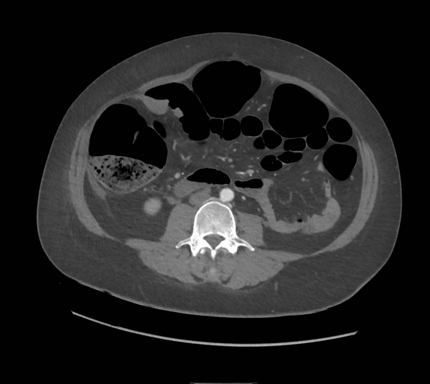 Colonic pseudo-obstruction (Radiopaedia 79752-92980 A 103).png