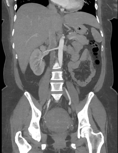File:Colonic pseudo-obstruction (Radiopaedia 79752-92980 B 37).png