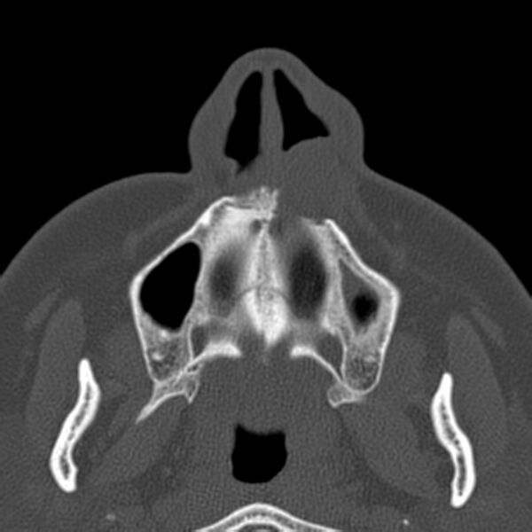 File:Nasolabial cyst (Radiopaedia 33987-35205 Axial bone window 8).jpg
