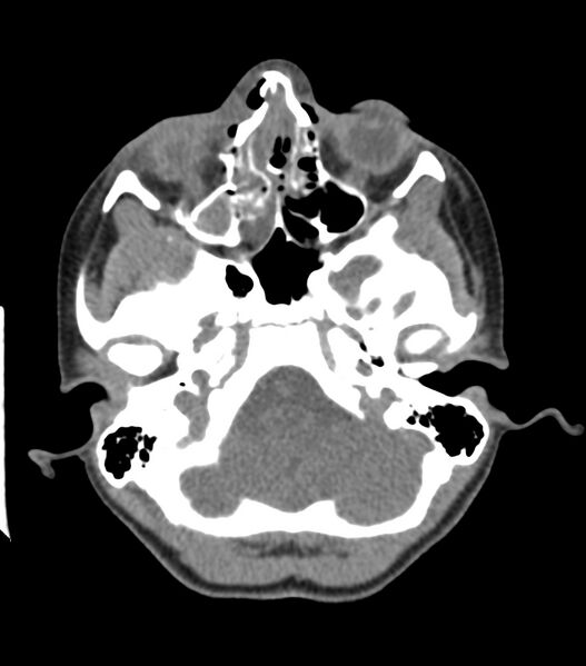 File:Nasoorbitoethmoid fracture (Radiopaedia 90044-107205 Axial 108).jpg