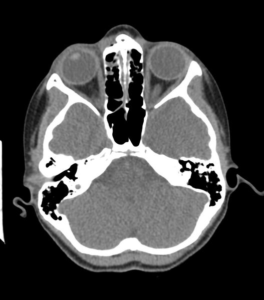 File:Nasoorbitoethmoid fracture (Radiopaedia 90044-107205 Axial non-contrast 159).jpg