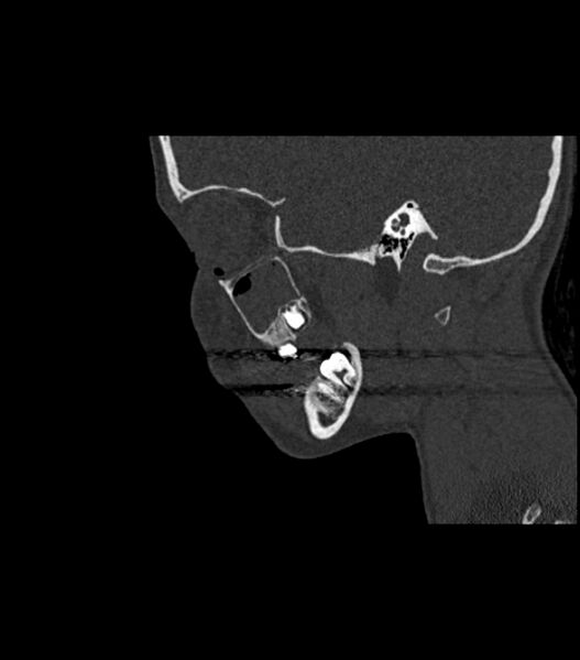 File:Nasoorbitoethmoid fracture (Radiopaedia 90044-107205 Sagittal bone window 102).jpg