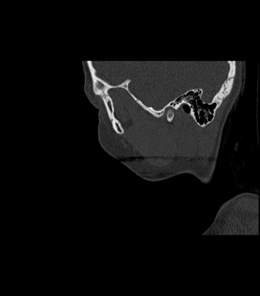File:Nasoorbitoethmoid fracture (Radiopaedia 90044-107205 Sagittal bone window 120).jpg