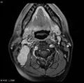 Nasopharyngeal carcinoma (Radiopaedia 4546-6667 Axial T1 C+ fat sat 19).jpg