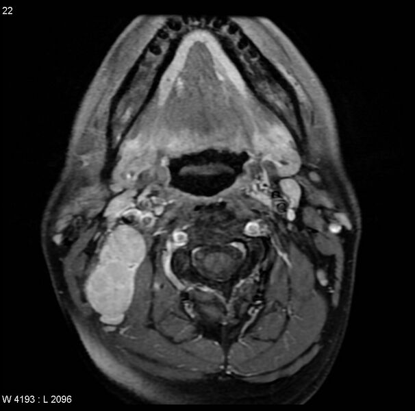 File:Nasopharyngeal carcinoma (Radiopaedia 4546-6667 Axial T1 C+ fat sat 19).jpg