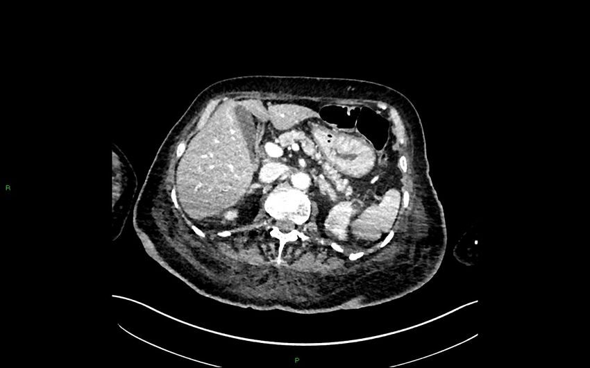 Neo-terminal ileal stricture (Crohn disease) (Radiopaedia 33790-34948 A 129).jpg
