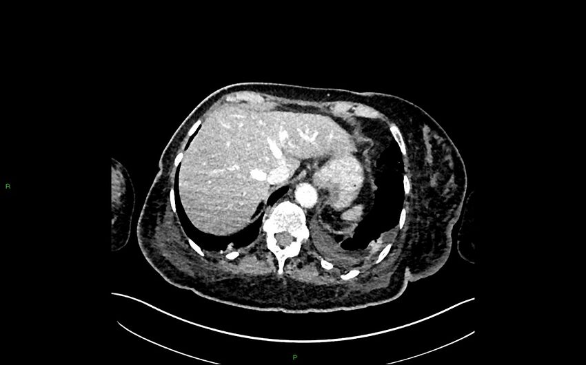 Neo-terminal ileal stricture (Crohn disease) (Radiopaedia 33790-34948 A 61).jpg