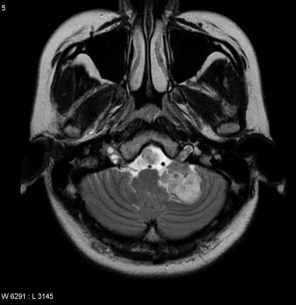 File:Neurofibromatosis type 2 - cranial and spinal involvement (Radiopaedia 5351-7111 Axial T2 2).jpg