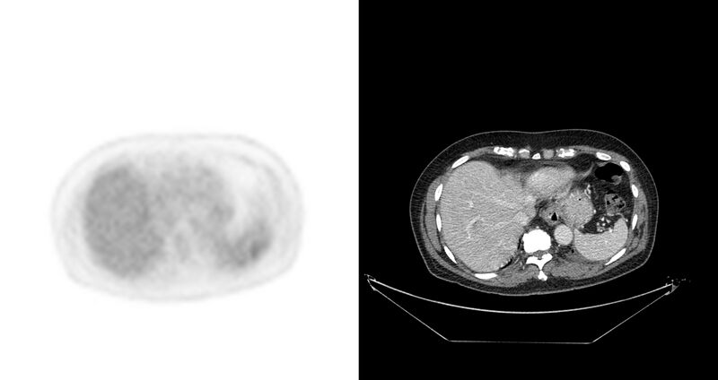 File:Non-Hodgkin lymphoma involving seminal vesicles with development of interstitial pneumonitis during Rituximab therapy (Radiopaedia 32703-33675 axial PET CT 39).jpg