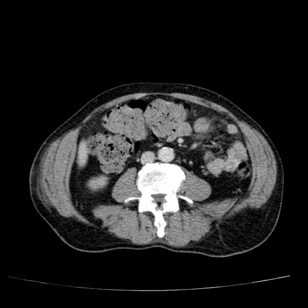 File:Non small-cell lung cancer (Radiopaedia 24467-24769 C+ delayed 83).jpg