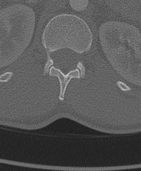 File:Normal CT thoracic spine (Radiopaedia 40181-42688 Axial bone window 105).png