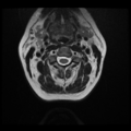 Normal cervical and thoracic spine MRI (Radiopaedia 35630-37156 Axial T2 24).png