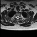 Normal cervical and thoracic spine MRI (Radiopaedia 35630-37156 H 39).png