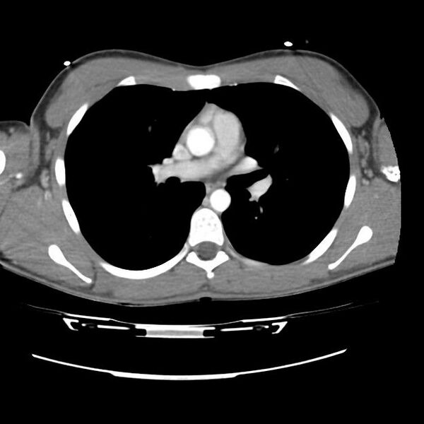 File:Normal dual-phase trauma CT chest,abdomen and pelvis (Radiopaedia 48092-52899 A 25).jpg