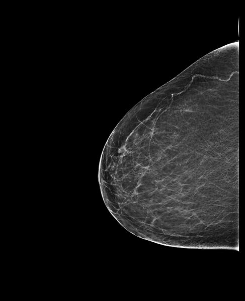 File:Normal mammography (low density breasts) (Radiopaedia 77169-89175 CC 1).jpg