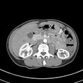 Normal multiphase CT liver (Radiopaedia 38026-39996 B 38).jpg