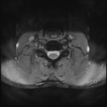 Normal trauma cervical spine (Radiopaedia 41017-43762 Axial T2 20).png