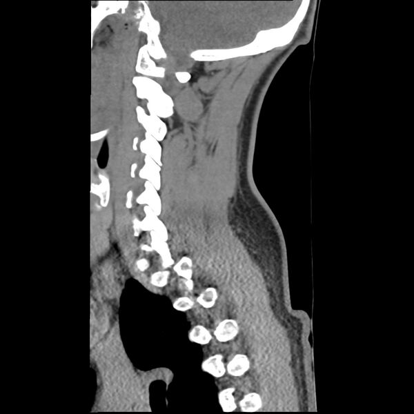 File:Normal trauma spine imaging (Radiopaedia 31753-32686 A 12).jpg