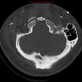 Occipital condyle fracture (Radiopaedia 18366-18208 Axial bone window 11).jpg