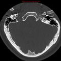 Occipital condyle fracture (Radiopaedia 18366-18208 Axial bone window 2).jpg