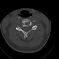 Occipital condyle fracture (Radiopaedia 31755-32691 Axial bone window 35).jpg